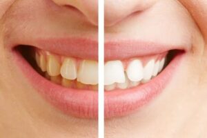 teeth whitening before and after