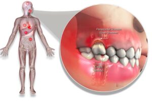 periodontal disease gum disease