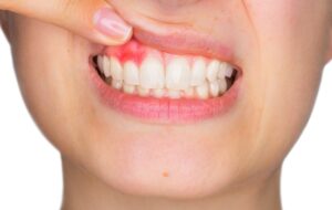 gingivitis wurzbach parkway