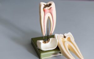 root canal 3d model