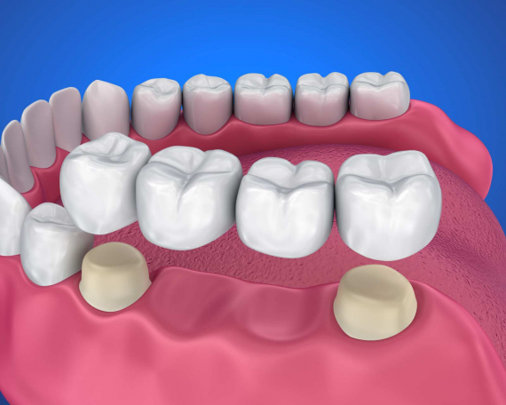 Dental Inlays & Onlays San Antonio